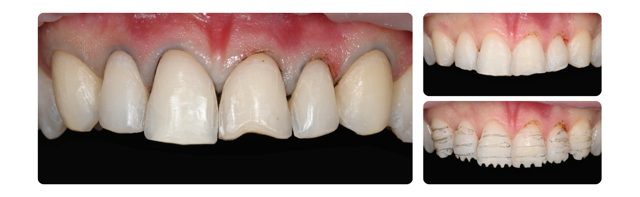 Preparatie - Diagnostische Wax-up